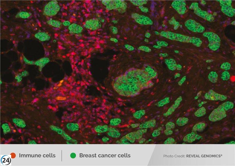 Descubren conexión entre el sistema inmunológico y la supervivencia en pacientes con cáncer de mama.